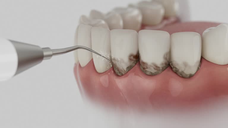 Trusted Wisdom Tooth Removal service in Lower Grand Lagoon, FL - Dentist Open Now
